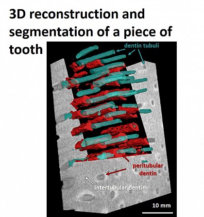 Tooth in XRM